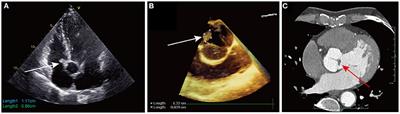 Case report: Minimally invasive excision of multifocal cardiac papillary fibroelastomas involving right atrium and aortic valve